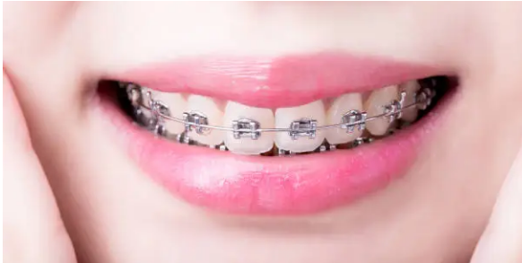 dental braces Adelaide